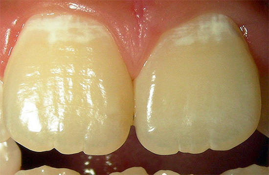 ขั้นตอนเริ่มต้นของแผลมีรอยช้ำของฟันเรียกว่าขั้นตอนของจุดขาวหรือชอล์ก