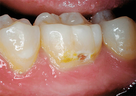 Và ở đây sâu răng trong khu vực cổ tử cung đã gần như đạt được dentin ...
