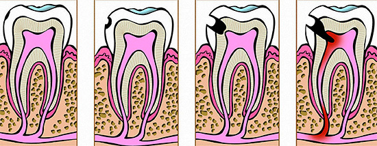 Stages of caries development: from the initial form to the pulpitis.