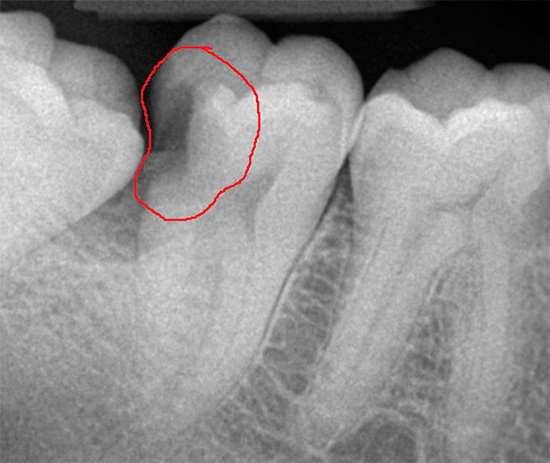 Denna röntgenstråle visar en djup karisk hålighet på tandens kontaktyta.