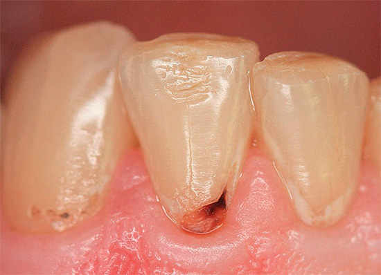 Another example of destruction in the neck of the tooth.