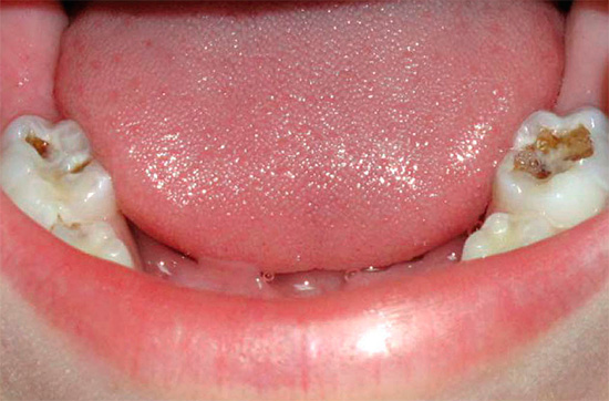 Med sådana djupa karies kan klyvning av en försvagad tandvägg lätt uppträda på tuggytorna, för att inte tala om den höga risken att utveckla pulpit.