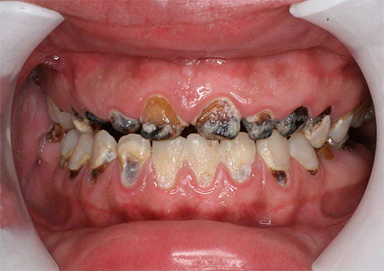 Les caries généralisées entraînent la destruction simultanée de nombreuses dents de la cavité buccale.