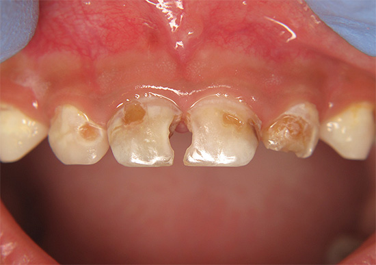 यदि आप लंबे समय तक दंत चिकित्सक की यात्रा स्थगित कर देते हैं, उदाहरण के लिए, पहले से ही बिना किसी दांत के बच्चे को छोड़ा जा सकता है।