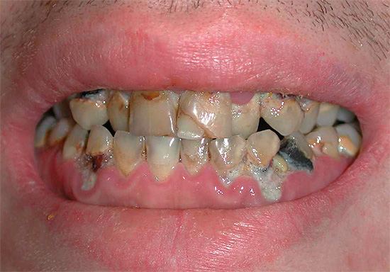 Hetzelfde geldt voor volwassenen - de foto toont een voorbeeld van meerdere cariës, wanneer bijna alle tanden tekenen van vernietiging vertonen.