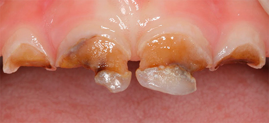 Nella forma acuta, la carie può distruggere i denti in un breve periodo di tempo ...