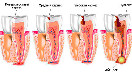 Deze foto toont de opeenvolging van stadia waardoor een tand passeert als deze door cariës wordt beschadigd, als deze niet wordt behandeld.
