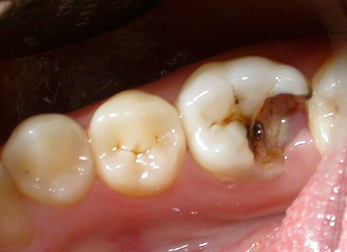Parece um dente com uma cavidade profunda e cariada antes do tratamento