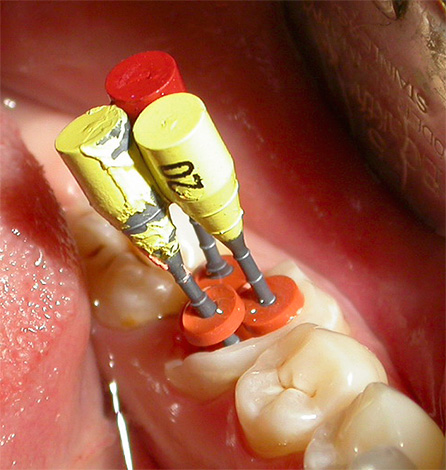 عند الإمساك بمثل هذه الأسنان ، من الضروري تنظيف وتعبئة جميع قنوات الجذر دفعة واحدة.