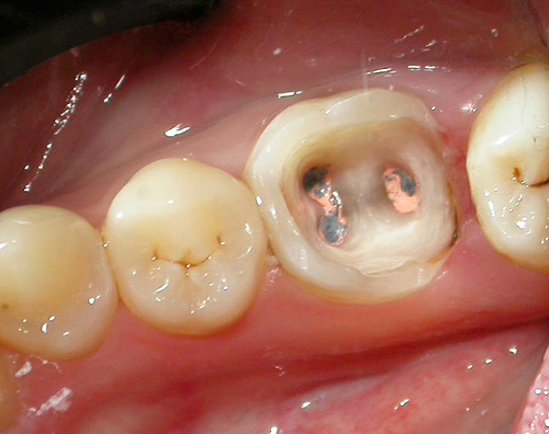 L'ulteriore destino del dente dipende in gran parte dalla qualità del trattamento canalare, quindi questa fase è molto responsabile.