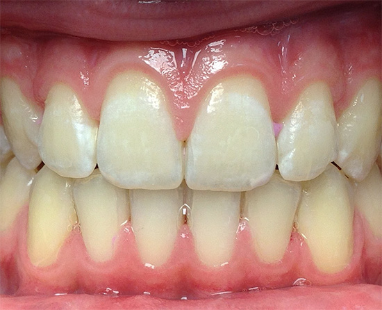 At the stage of initial caries, treatment can be performed without using a drill - by the method of remineralizing therapy