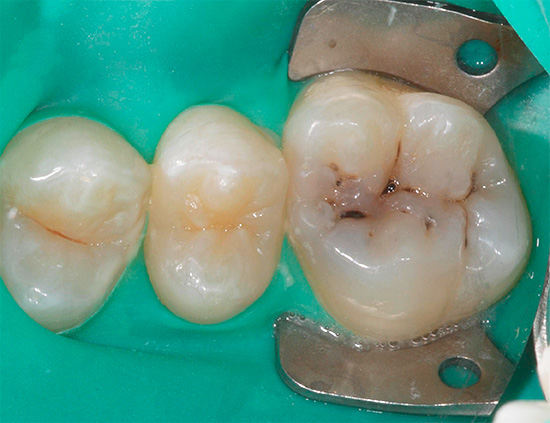The photo shows the preparation of a tooth with fissure caries for treatment: the affected tissues will be excised, after which they will be replaced by filling material.
