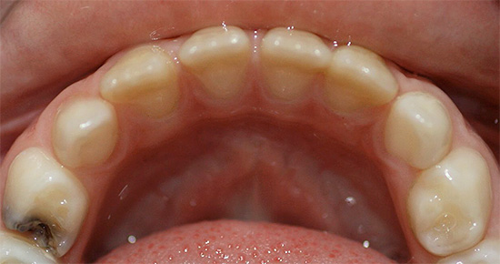 En karies process kan påverka en enda tand, medan alla andra är friska.