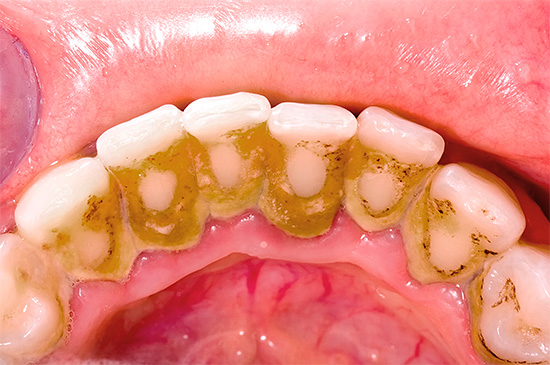 En présence de dépôts dentaires, il est nécessaire de demander au dentiste de les retirer, car les caries peuvent commencer à se développer et se cacher derrière eux.