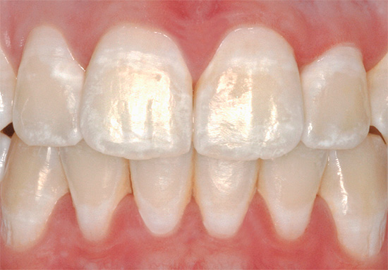 จุดด่างขาวบนฟันเป็นพื้นที่ของเคลือบฟันแร่