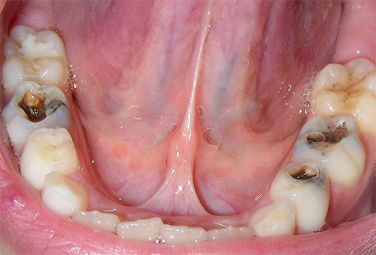 تظهر الصورة عدة أسنان متضررة من تسوس عميق ، ومن هذه الحالة قريبة من التهاب لب السن ، عندما يضطر العلاج إلى إزالة العصب.