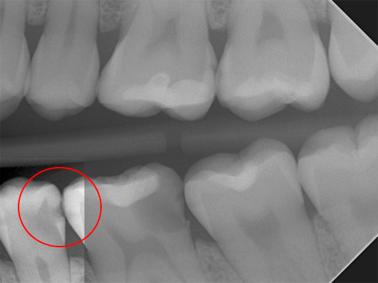 على الأشعة السينية مرئية تجويف خبيث مرئية على سطح التماس من الأسنان.
