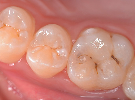 Very often tooth fissures are affected by caries - natural cavities on its chewing surface.