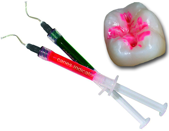 وتستخدم على نطاق واسع علامات تسوس من ألوان مختلفة اليوم في طب الأسنان للكشف البصري للمناطق carious من المينا والعاج.