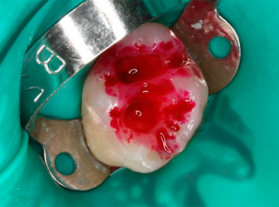 संक्रमित दंत चिकित्सा को हटाने की गुणवत्ता को नियंत्रित करने के लिए - एक कैरी मार्कर का उपयोग करके साफ गुहाओं की नक्काशी के बाद तैयारी की गई थी।
