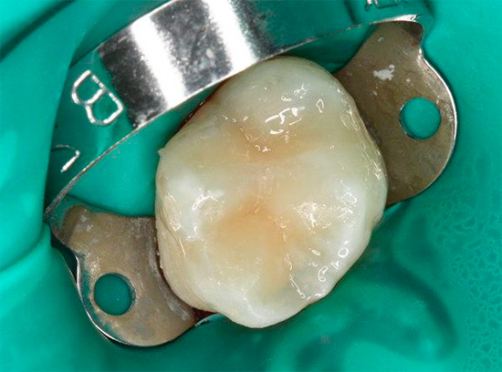 وهكذا يبدو وكأنه الأسنان مغلقة بالفعل بعد العلاج.