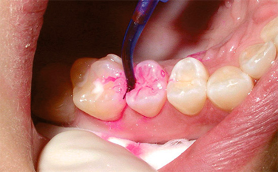 Es wird normalerweise nicht empfohlen, viele Zähne gleichzeitig mit einem Kariesmarker zu behandeln, da die Expositionszeit der Lösung eher gering ist, so dass Sie möglicherweise keine Zeit haben, den Indikator abzuwaschen.