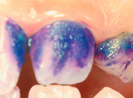 फोटो मेथिलिन ब्लू के साथ दांत धुंधला करने का एक उदाहरण दिखाता है, जिसका उपयोग इस मामले में प्रारंभिक क्षरणों का पता लगाने के लिए किया जाता है।