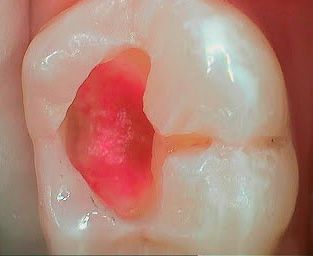 Lorsqu'une dent est préparée, la dentine atteinte de carie est retirée jusqu'à ce qu'elle cesse de se colorer avec un marqueur.