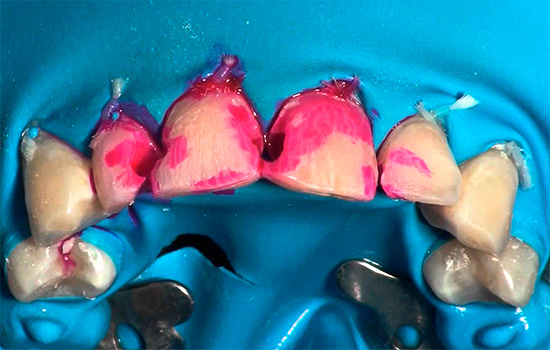Synthetic dye fuchsin paints caries-affected tissues in bright red.