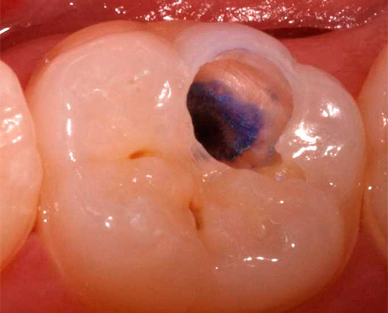 And this is what the indicator-colored cavity looks like after washing with water.