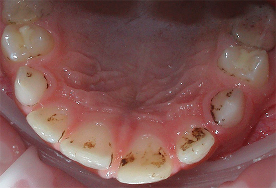 Loại bỏ cao răng ở phụ nữ mang thai được chống chỉ định trong tam cá nguyệt đầu tiên.