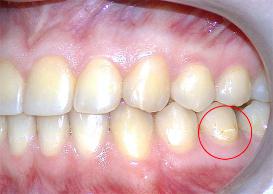 In some cases, only separate foci of initial caries appear during pregnancy, and women do not hasten to treat them, trying to wait out this crucial period.