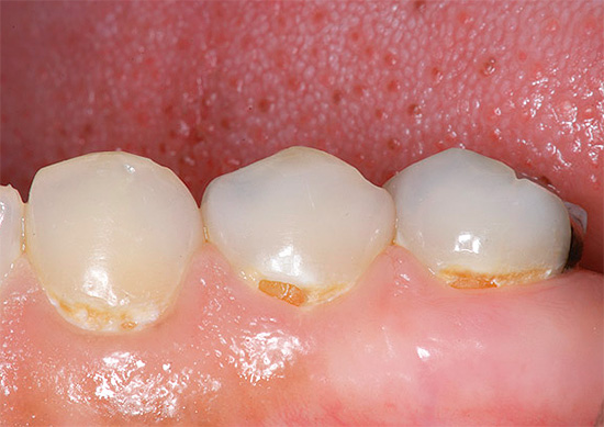 Sometimes caries during pregnancy can turn into an acute form with a strong and simultaneous lesion of many teeth at once.