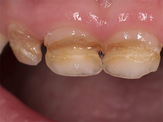 Кариесът на млечните зъби е особено разпространен днес при децата (снимката показва пример)