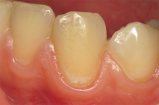 Decay caries