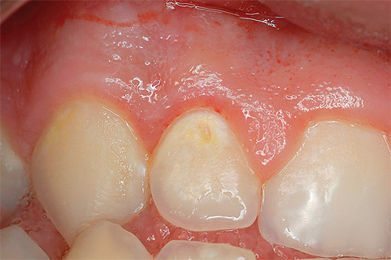 ฟันผุ (มันเป็นที่ชัดเจนว่าเคลือบฟันได้เริ่มขึ้นแล้วที่จะมีเม็ดสีในประเทศ)
