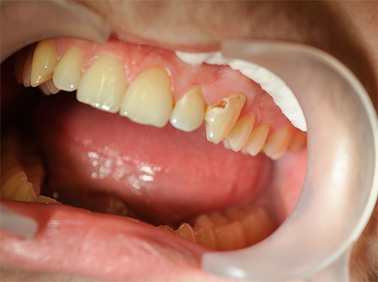 And this photo shows an example of average caries, at this stage of development of the pathological process, very pronounced painful sensations are already possible.