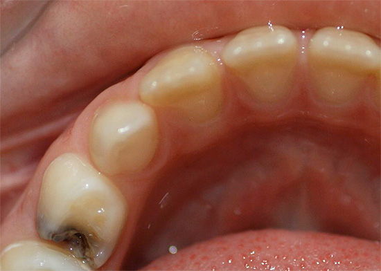 गहरी क्षय (चित्रित) के साथ, रोगजनक प्रक्रिया दंत चिकित्सा को प्रभावित करती है और दांत के लुगदी कक्ष के करीब आ सकती है।