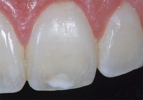 จุดสีขาวบนเคลือบฟันในโรคเรื้อรังโรคเรื้อรังอาจไม่ถูกรบกวนเป็นเวลานานมาก ...
