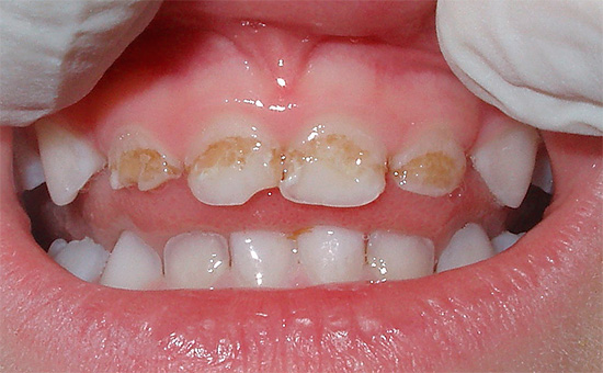 But with acute caries, the hard tissues of the tooth can be destroyed literally in a matter of weeks or months.