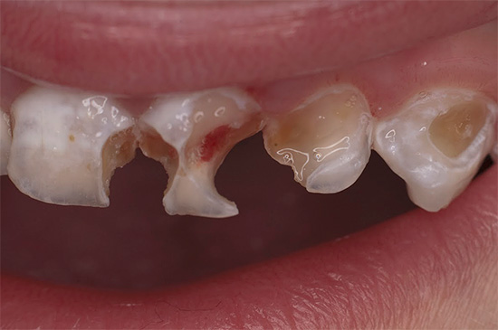 The photo shows an example of multiple lesions of milk teeth with bottle caries.