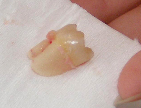 Na ausência do tratamento iniciado a tempo, pode ser necessário remover um dente de leite, que às vezes tem uma influência séria na formação da mordida em uma criança.