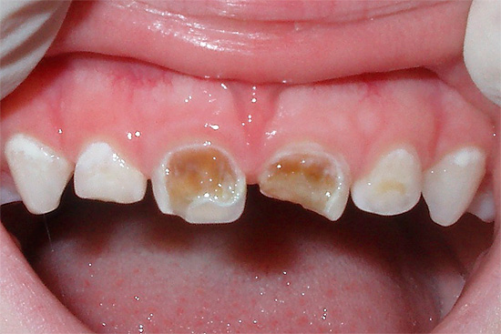 In spite of the fact that milk teeth will fall out soon, it is necessary to treat caries on them.
