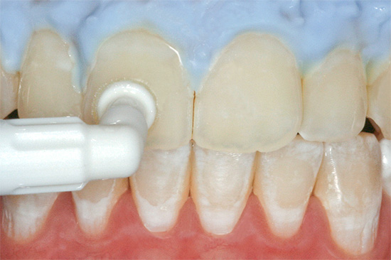 يمكن الشفاء من التسوس في مرحلة البقع البيضاء بالطرق المحافظة - عن طريق استعادة مينا الأسنان بعوامل معدنية خاصة.