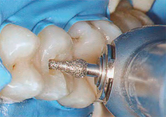 إذا تم تدمير مصفوفة البروتين في المينا عن طريق التسوس ، في معظم الحالات ، سيكون من الضروري استخدام مثقاب الأسنان مع التثبيت اللاحق لختم بدلا من الأنسجة المفقودة.