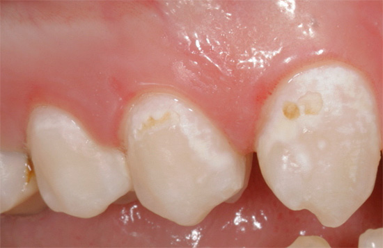 ภาพแสดงตัวอย่างของสีขาวและสูญหายแว่นตาแร่ demineralized (ฟันผุครั้งแรก)