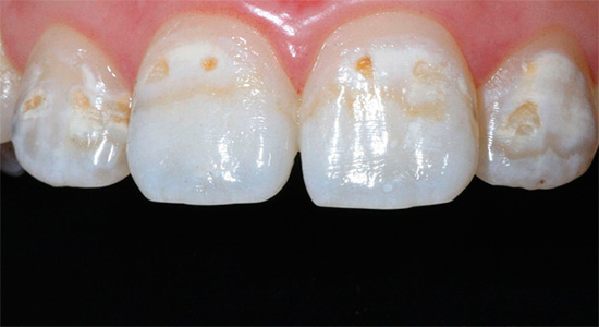 ถ้าคุณไม่ป้องกันการสูญเสียแร่ธาตุเพิ่มเติมจากการเคลือบฟันฟันก็จะยุบลงไปกับฟันผุลึก ๆ