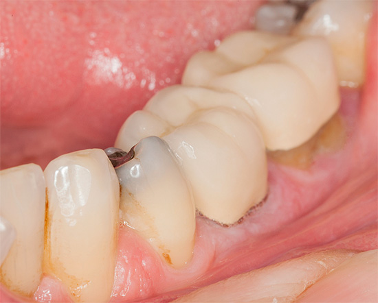 แม้ว่าจะเชื่อกันว่าฟันผุสามารถเคลื่อนที่จากฟันหนึ่งไปยังฟันอื่นได้ แต่นี่เป็นความเข้าใจผิด