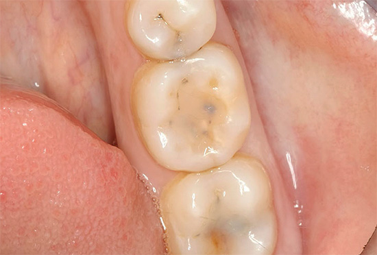 اليوم ، في العديد من البلدان ، يعاني كل شخص بالغ تقريبا من آفات مزعجة للأسنان.