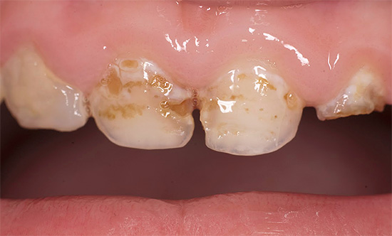 Oft ist die Behandlung von Karies an den Zähnen des Kindes bei einem Kind wesentlich komplexer als bei Erwachsenen.